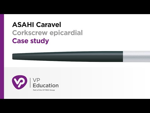 ASAHI Caravel Corkscrew epicardial Case study
