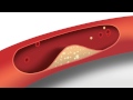 Blood Pressure Animation Heart Disease Risk Factors