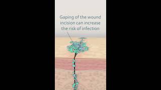 What causes wound infection?