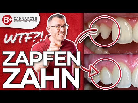 Alles zum Zapfenzahn - Wie aufbauen? Mit Veneer diesen Patientenfall lösen? Inkl. Vorher-Nachher