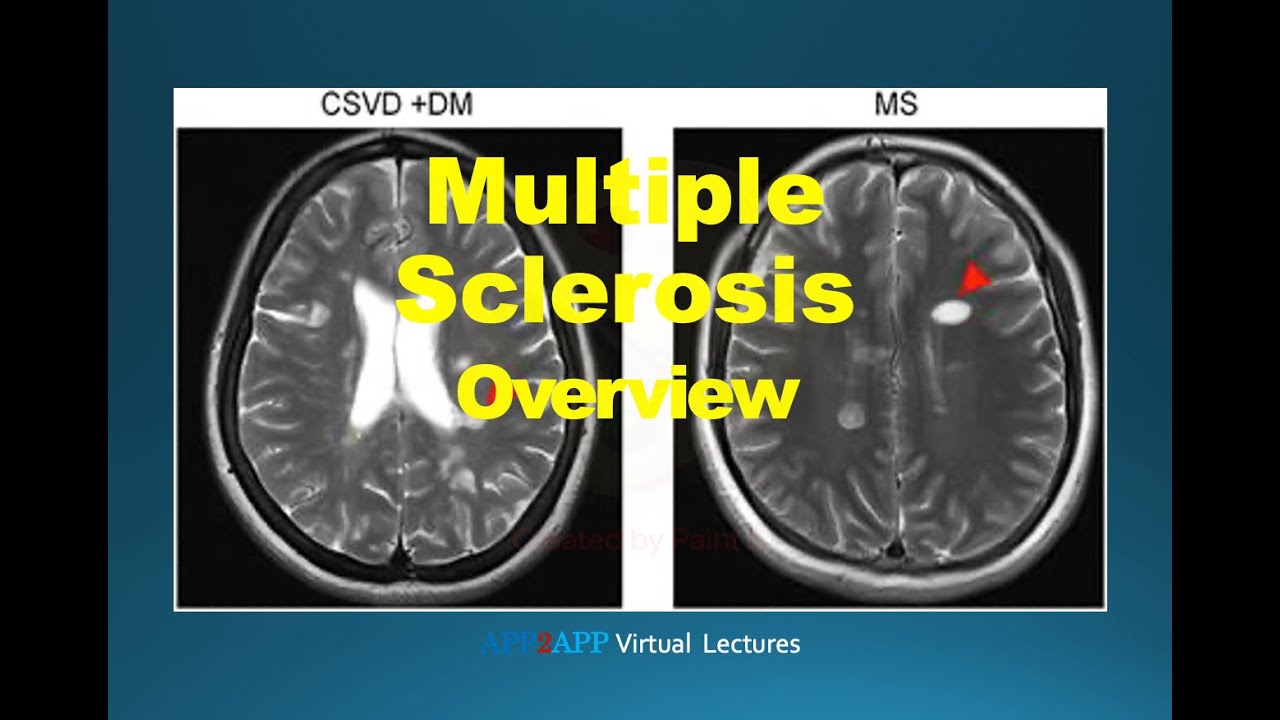 Multiple Sclerosis Overview - Part I