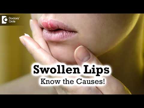 Swollen Lips: Common Causes,Triggers |  Angioedema  - Dr. Rashmi Ravindra | Doctors' Circle