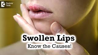 Swollen Lips: Common Causes,Triggers |  Angioedema  - Dr. Rashmi Ravindra | Doctors