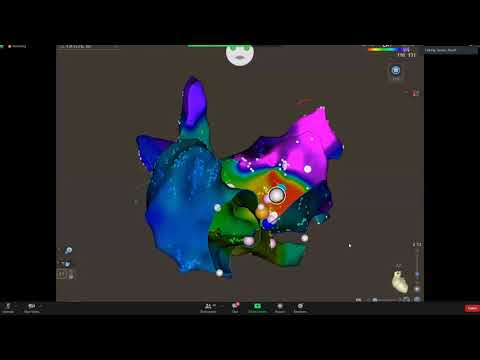 Atrial Flutter   Dr  Anwer Alzurfi