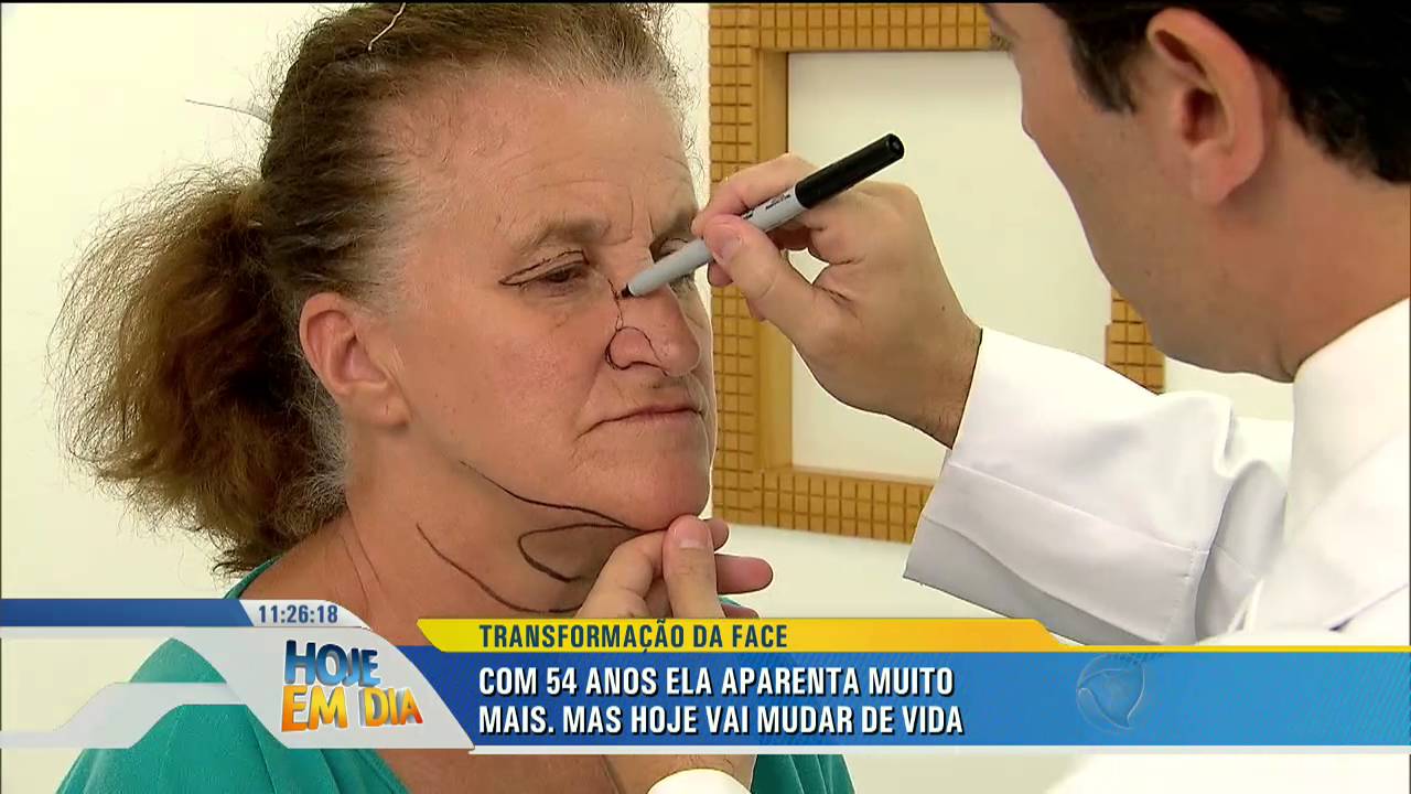 Transformação da face: Maria de Lourdes recupera a autoestima
