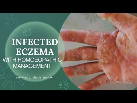 Infected eczema of My uncle