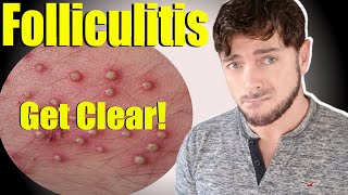 Folliculitis Skin Bumps | Get Clear Skin and Scalp | Causes and Cures