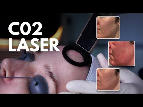 CO2 Laser Treatment Explained: Before & After Results, Recovery & Benefits