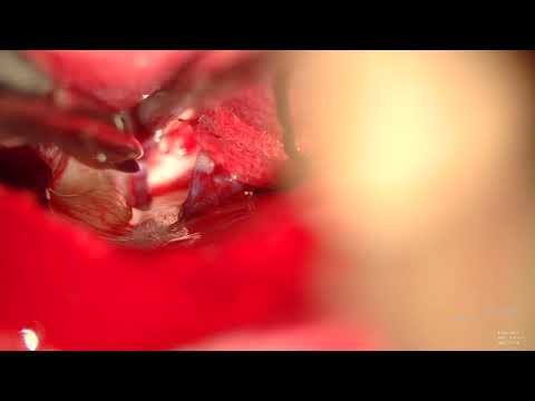 Microvascular Decompression for Trigeminal Neuralgia