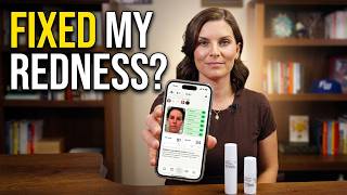 NollaDerm Review: How I Manage Rosacea and Acne From My Phone