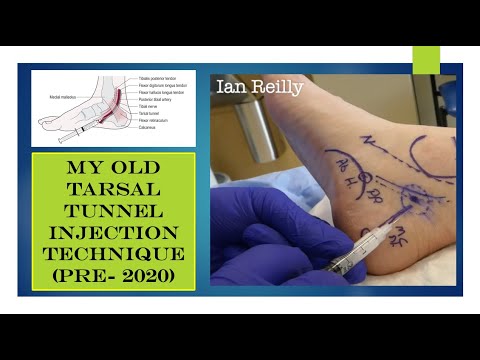 My old tarsal tunnel syndrome injection technique