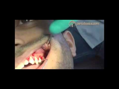 How to put internal bevel incision low