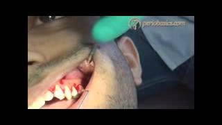 How to put internal bevel incision low
