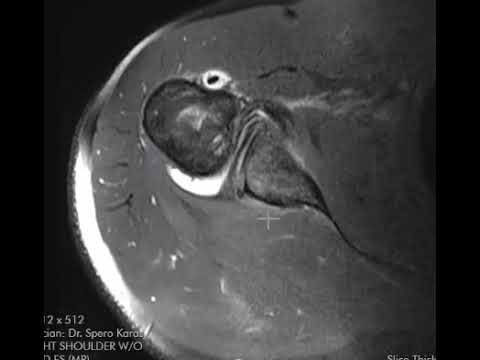 Reverse Hill-Sachs and reverse Bankart lesions