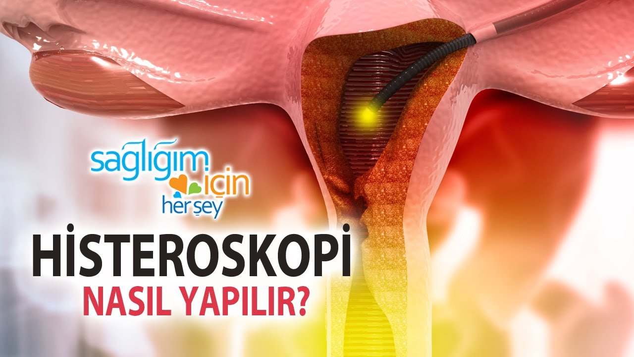 Histeroskopi Nasıl Uygulanır?