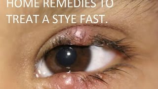 How to get rid of stye on your eyelid fast overnight 2016