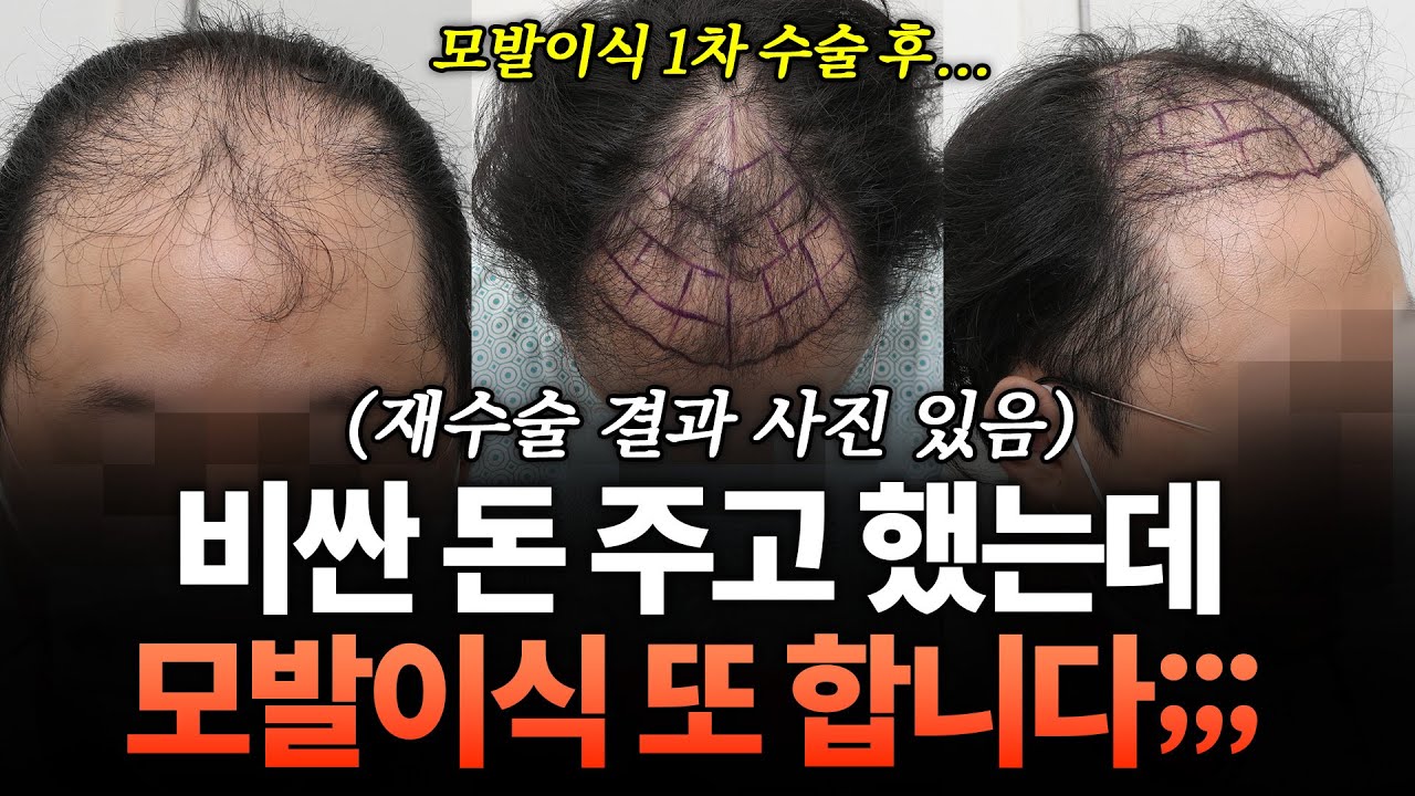 모발이식 실패할 수 있다고? 재수술하는 사람 특징