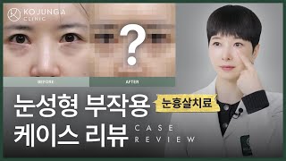 쌍꺼풀, 눈 앞트임 수술. 부작용 흉살 치료. 절개 자국도 없어질까요?