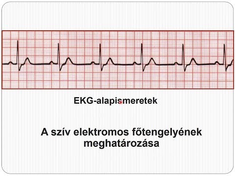 Az embereknél a magas vérnyomás gén dominál, Policisztás vesebetegség