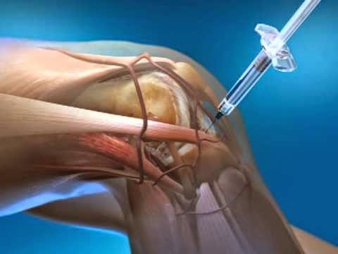 Aceite esencial y articulaciones Fisioterapia con artrosis deformante de la articulación de la rodilla