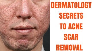 Acne scar treatments- ULTIMATE GUIDE