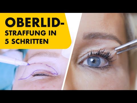 Meine Oberlidstraffung in 5 Schritten erklärt! Live bei der OP dabei | Asymmetrie | Dr. Jungwirth