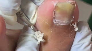 Ep_8743 Ingrown toenail removal 👣 เจ็บไหม..ไม่เท่าไรครับ 😅 (clip from Thailand)