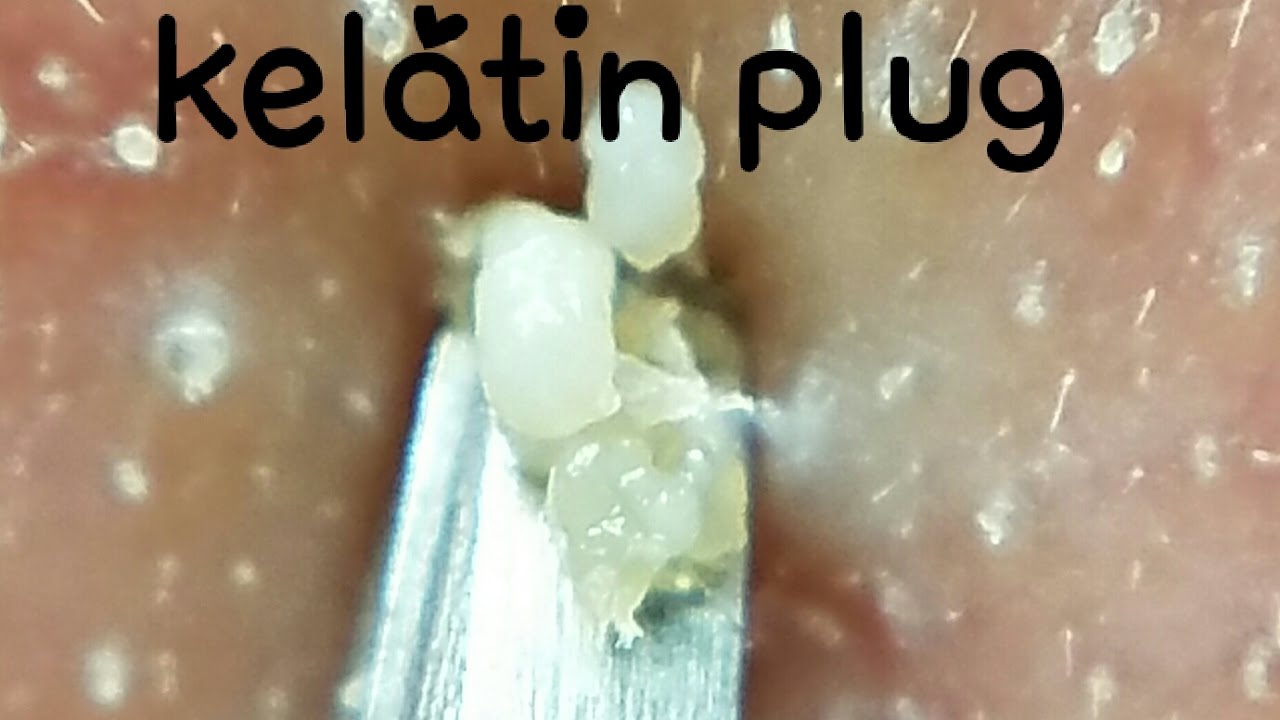 角栓ぬき&押し　I pulled out & push keratinplug.