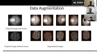 Brain Tumor Detection using Convolutional Neural Network