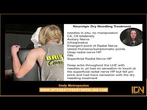 Recovering from Radial Nerve Palsy with Dry Needling 💉 | Clinical Relevance