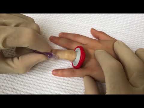  T Strip and Topical Laceration Closure