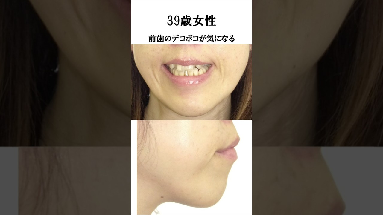 前歯デコボコの歯列矯正 #美容 #整形 #矯正歯科