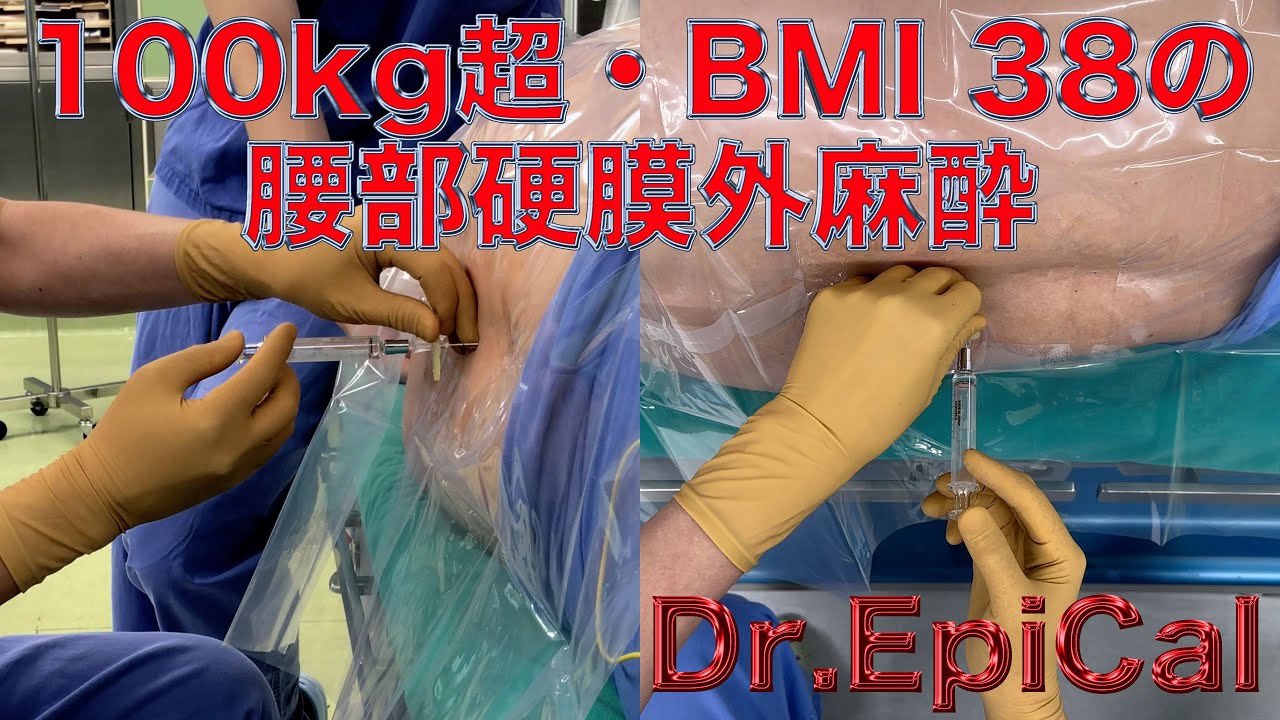 100kg超・BMI 38の腰部硬膜外麻酔 epidural anesthesia by Dr.EpiCal