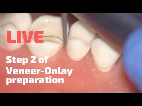 Live. Step 2 of Veneer-Onlay preparation