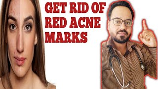 How to get rid of Red Acne Marks ( Post Inflammatory Erythema or PIE)