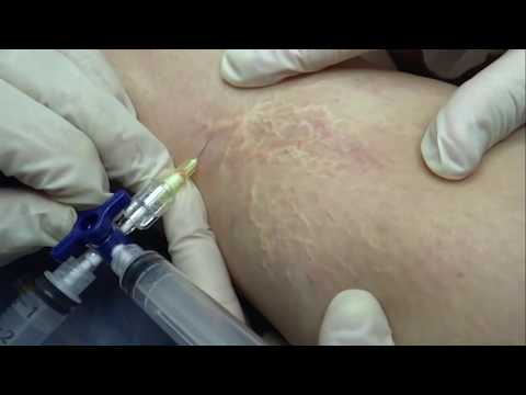 Tratamentul laserului varicos varicos în sevastopol