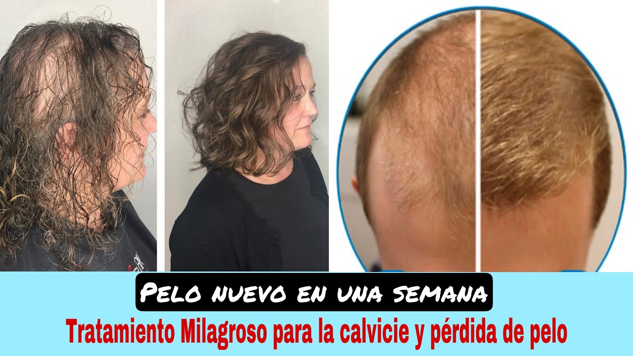 Esta mezcla RECUPERARÁ el cabello que perdiste??. Cabello fino, Calvicie y Crecimiento GARANTIZADO??