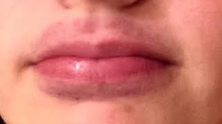 how to get rid of bruises on your lips at home