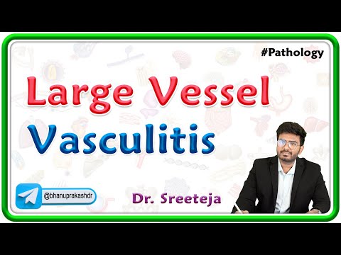 1. Large Vessel Vasculitis : Temporal Arteritis (Giant cell arteritis) & Takayasu arteritis : USMLE