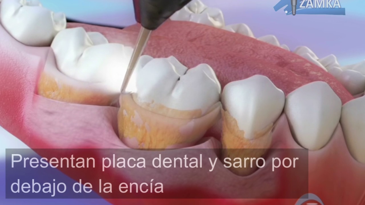 4 tipos de limpieza dental usado por los dentistas