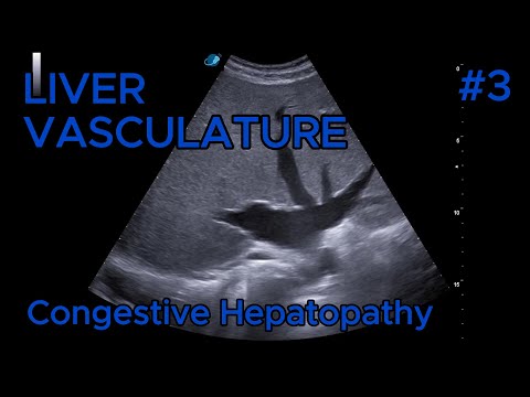 Congestive Hepatopathy video preview