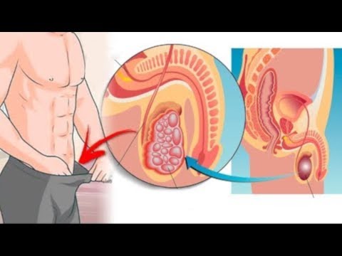 BPH Droge Escherichia coli in Prostata-