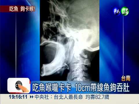 魚鉤卡喉! 嬤取"魚刺"竟拉出魚線