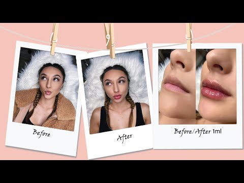 GETTING MY LIPS DONE || Needle-less lip filler experience before and after