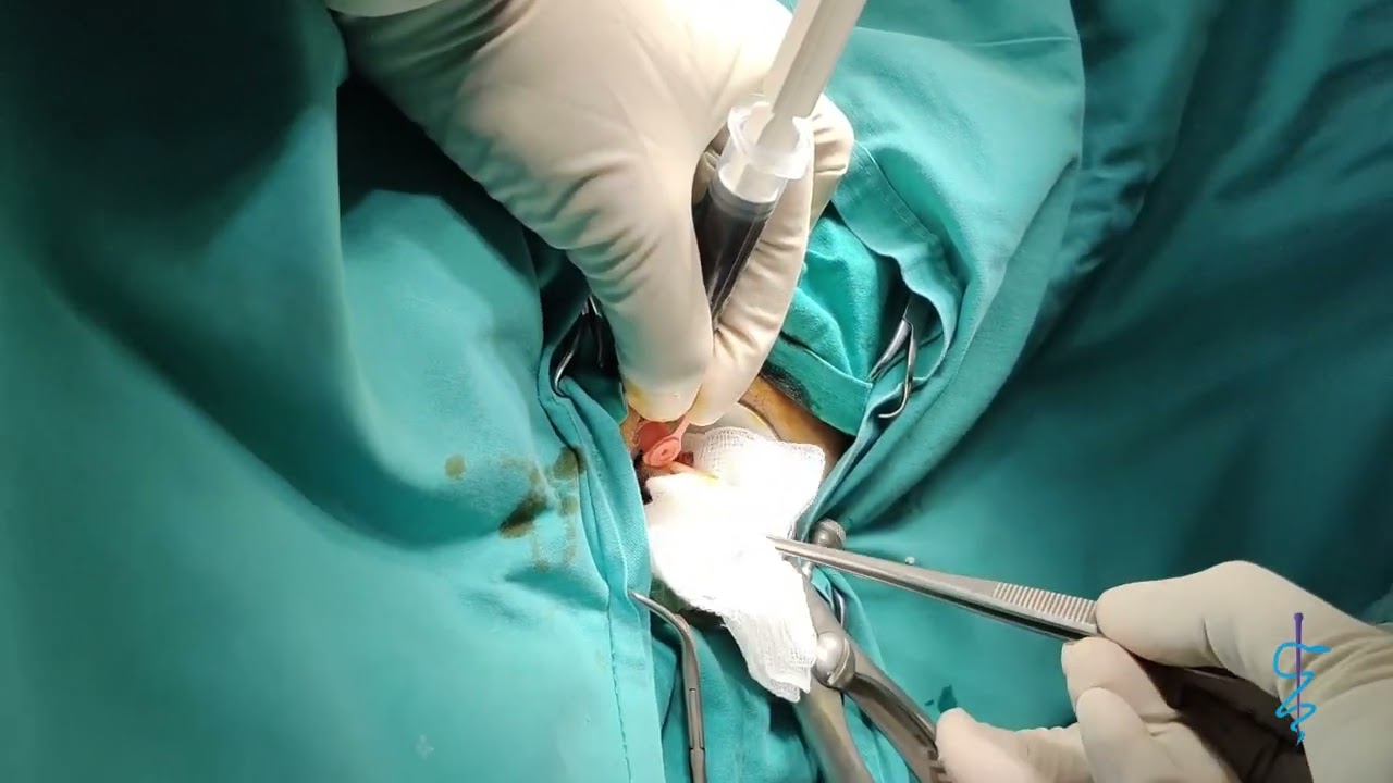 ΔΙΑΣΦΙΓΚΤΗΡΙΑΚΟ ΣΥΡΙΓΓΙΟ ΑΠΟΚΑΤΑΣΤΑΣΗ ΜΕ LASER DIODE