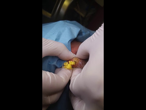 Camminare clic nelle articolazioni Quando le articolazioni fanno male al freddo