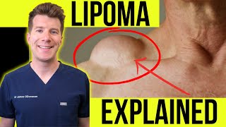 Doctor explains LIPOMA | Symptoms, clinical photos and treatment