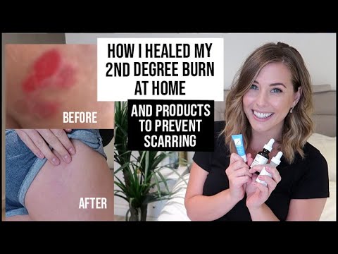 How I Healed My Burn Scar - Prevent A Burn From Scarring | xameliax