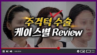 주걱턱이라고 다 똑같지 않다구? - 턱끝 모양에 따른 수술 전후 리얼 리뷰 1탄