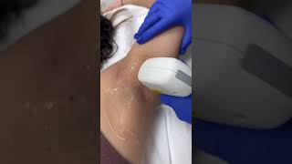 Underarm Laser Hair Removal #shorts #satisfying #antiaging #lasertreatment #laserhairremoval